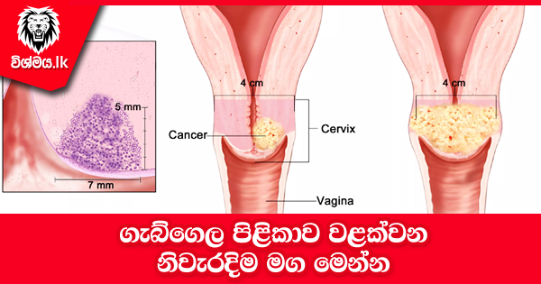 sinhala-articles-ගැබ්ගෙල-පිළිකාව-වළක්වන-මග-Health